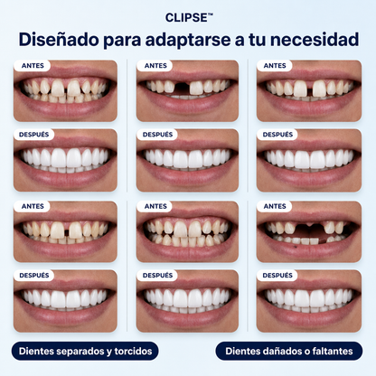 Carillas dentales Clipse®