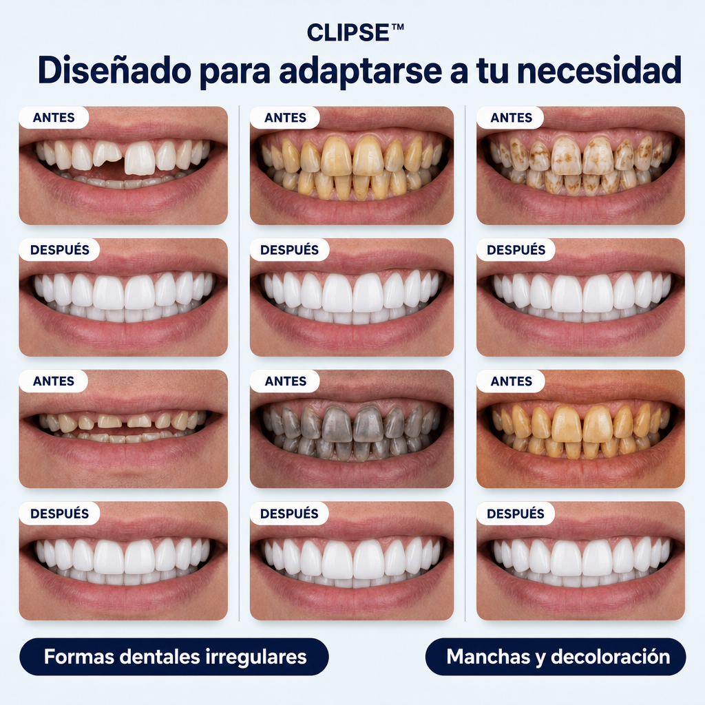 Carillas dentales Clipse®
