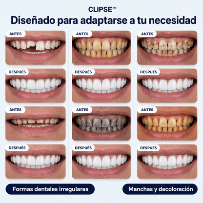 Carillas dentales Clipse®