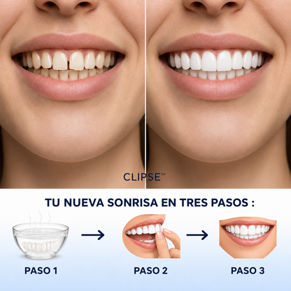 Carillas dentales Clipse®